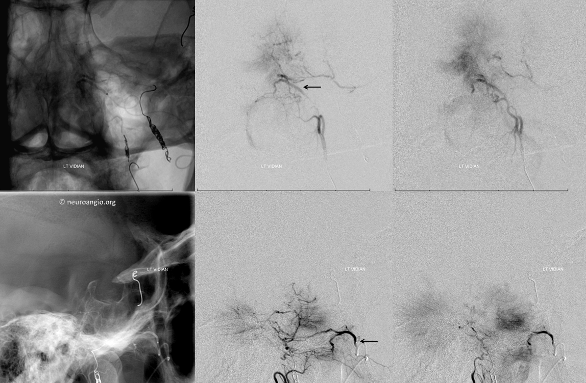 Meningioma embolization