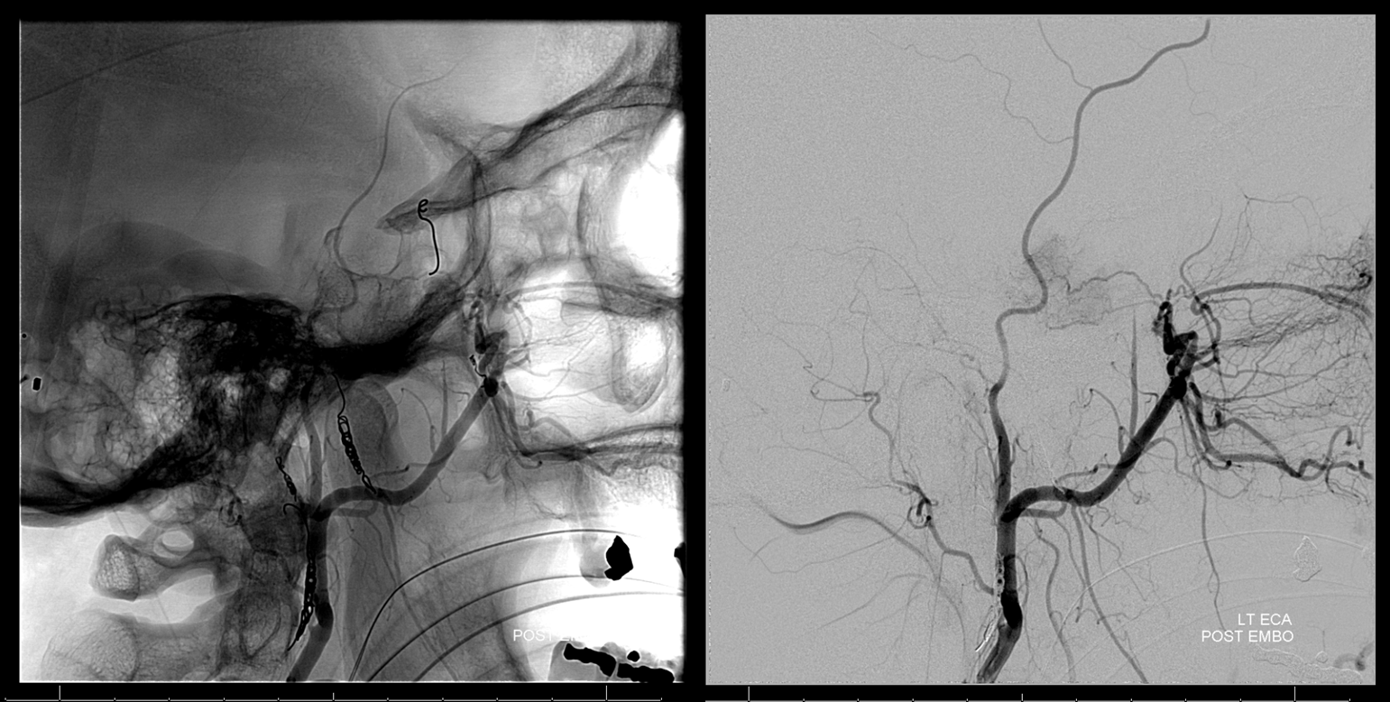 Meningioma embolization