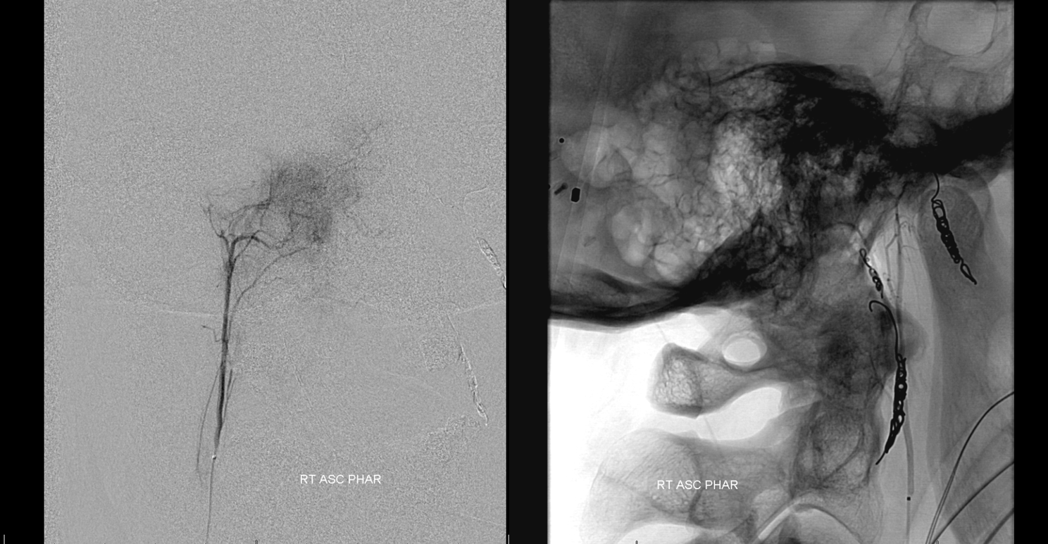 Meningioma embolization