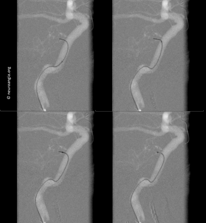 Meningioma embolization