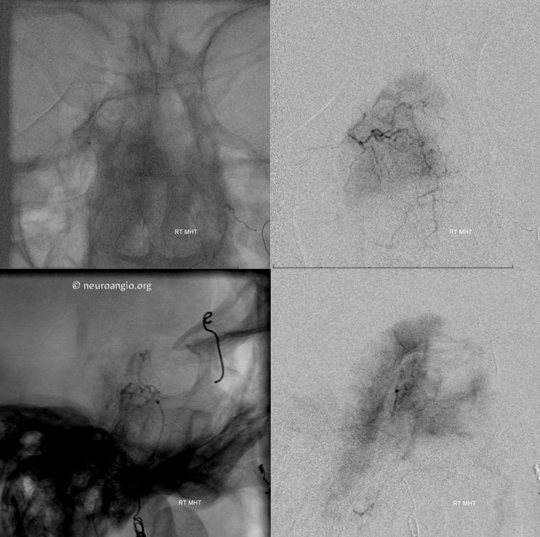 Meningioma embolization