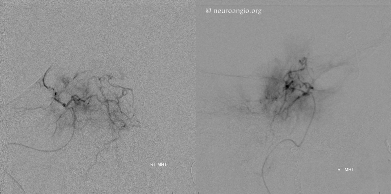 Meningioma embolization