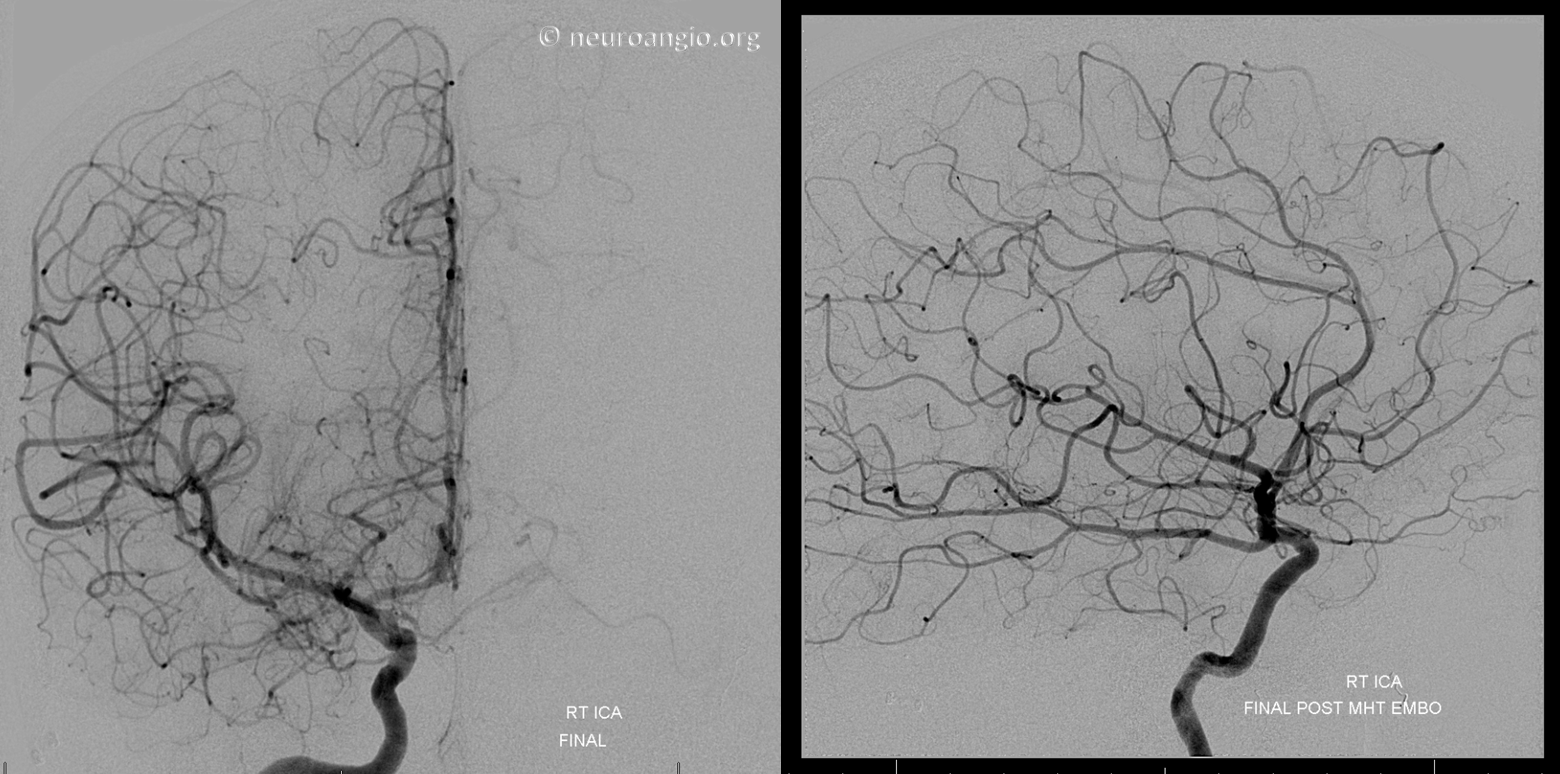 Meningioma embolization