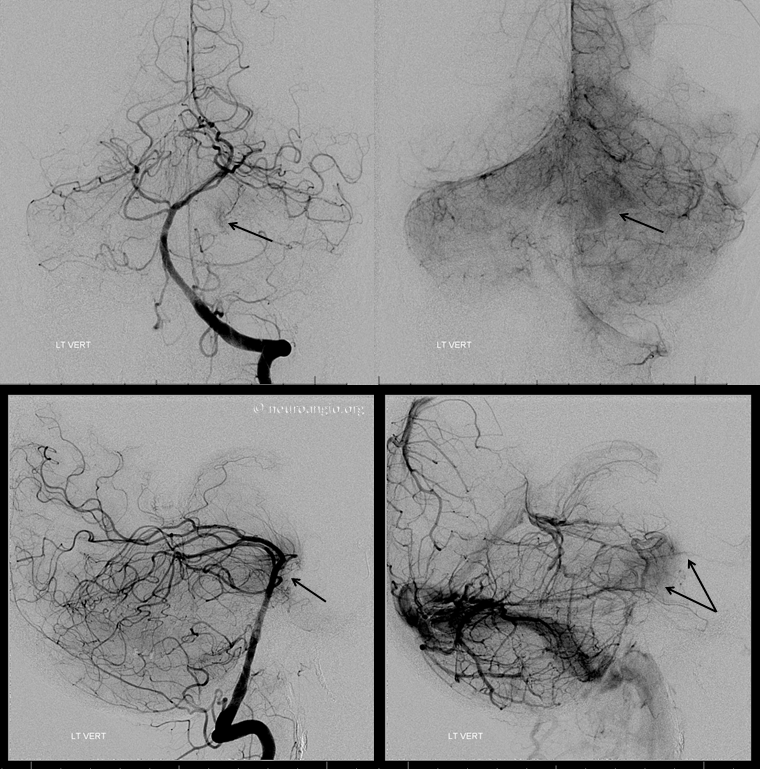 Meningioma embolization