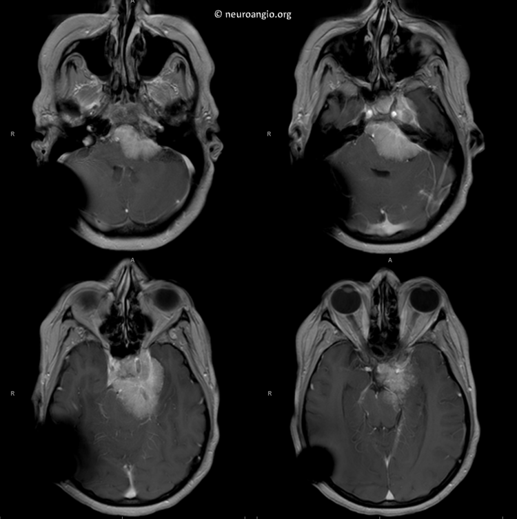 Meningioma embolization