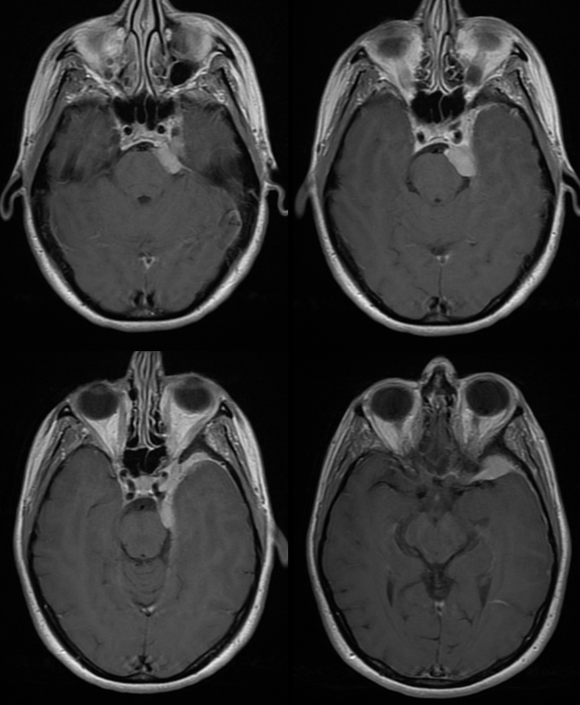 Archives Skull Base Meningioma Embolization MHT Access | neuroangio.org