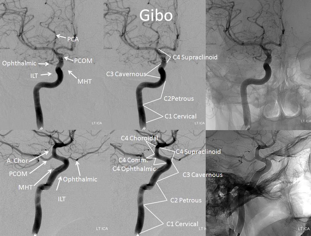 Internal Carotid Artery and Its Aneurysms | neuroangio.org