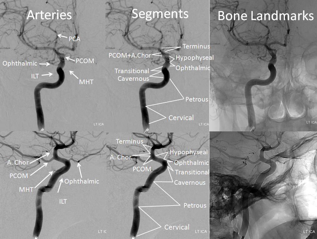 Internal Carotid Artery and Its Aneurysms | neuroangio.org
