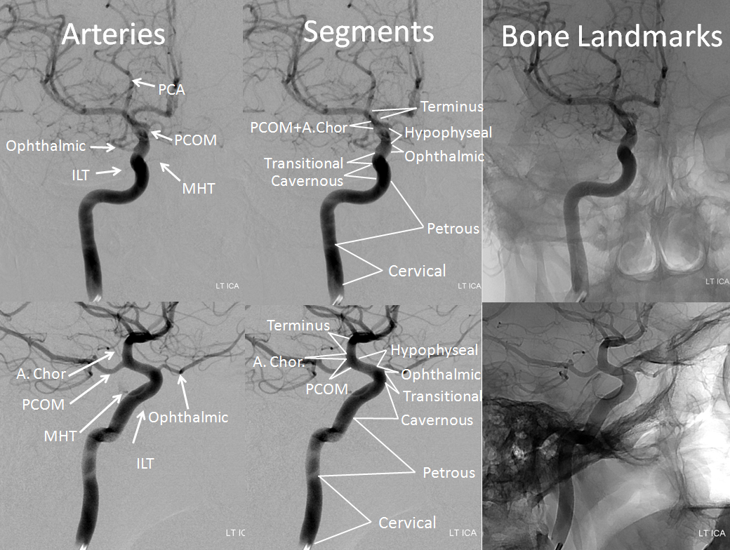 treatment enlarged carotid bulb