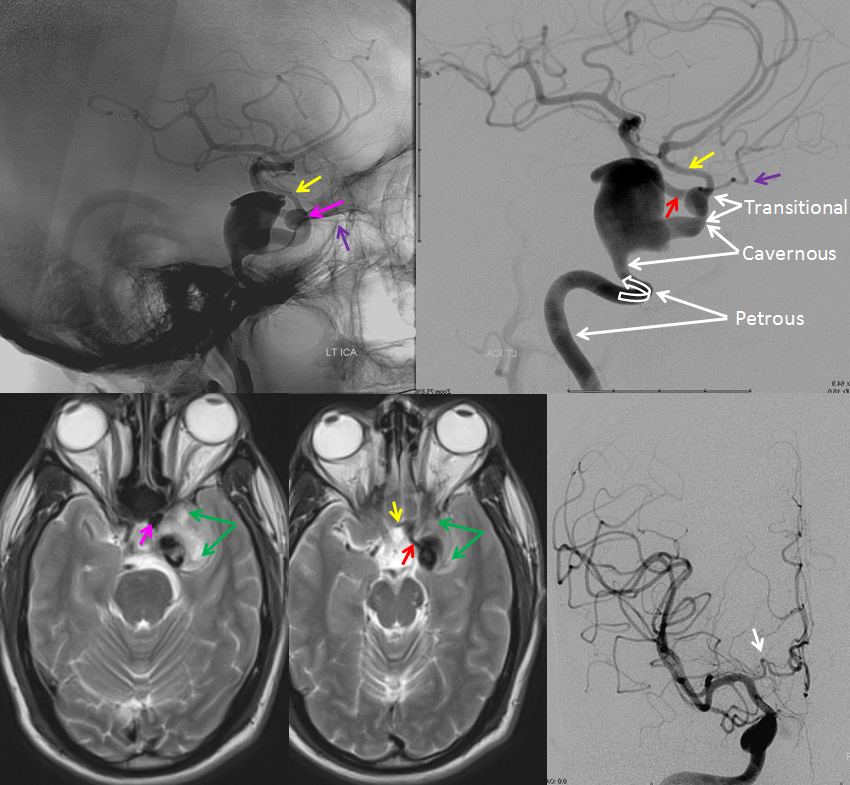 ophthalmic artery dissection