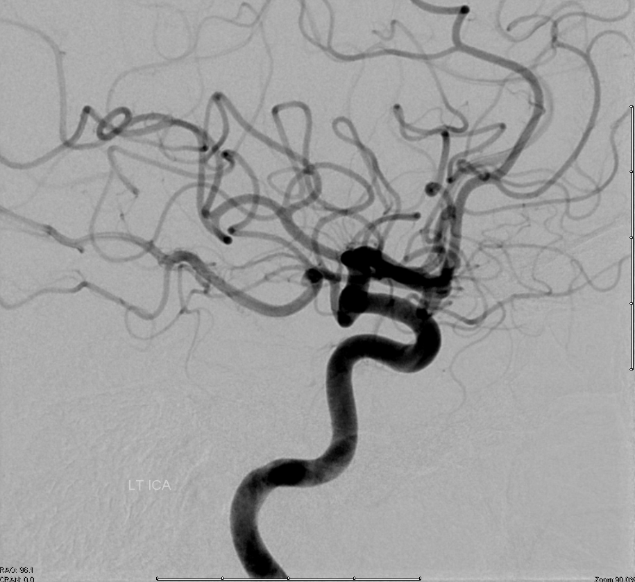 Distal ICA origin Ophthalmic Artery