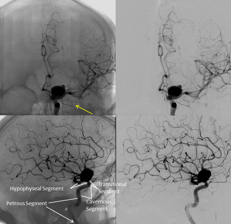 Hypophyseal Aneurysm