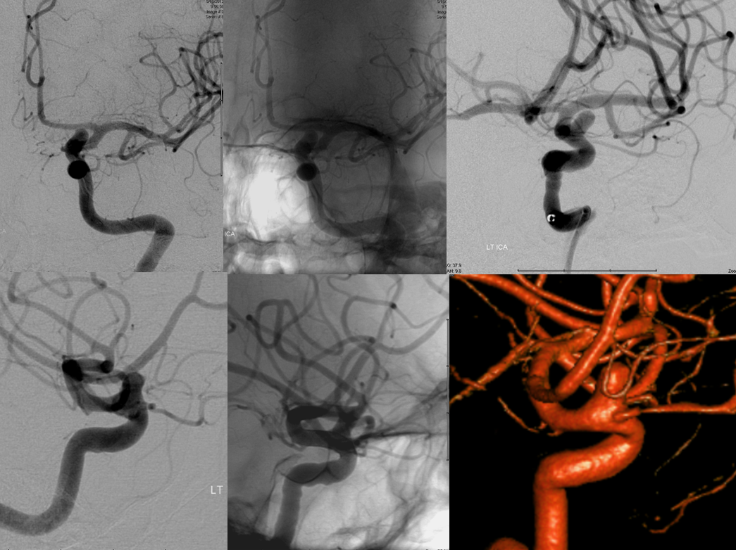 Superiorly projecting ophthalmic aneurysm