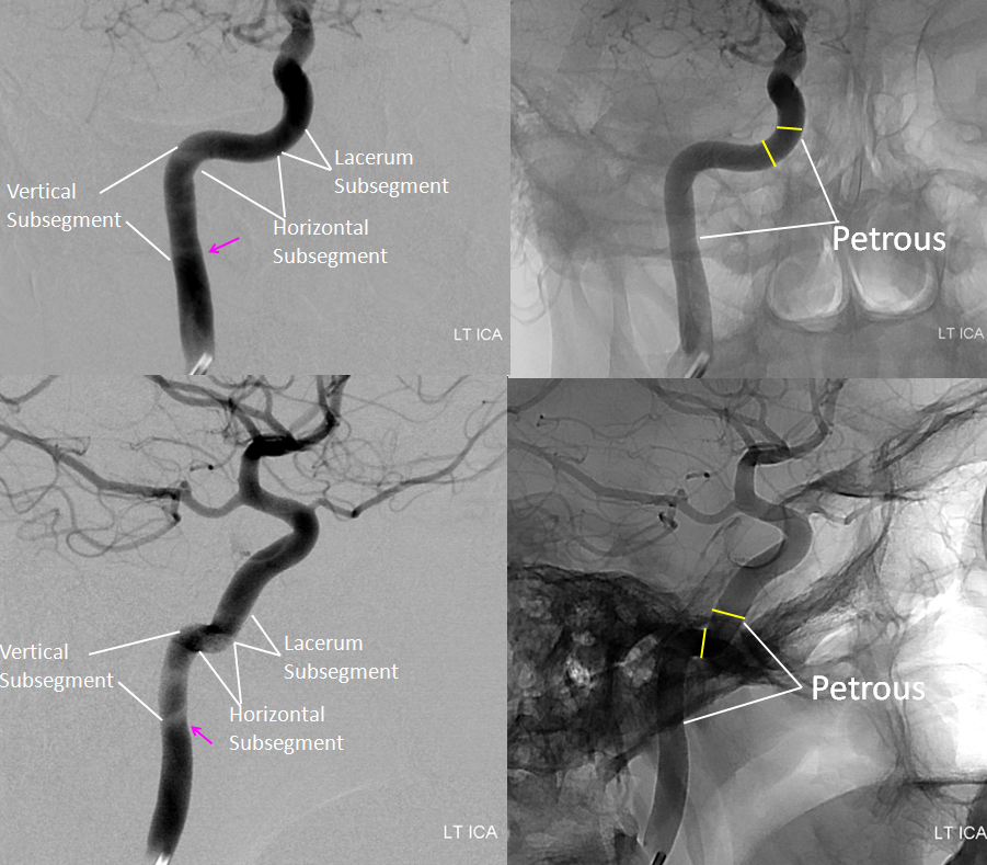 internal carotid artery angiogram