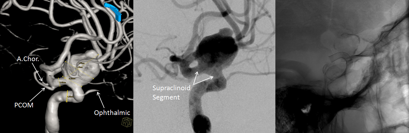 Dorsal Ophthalmic Artery