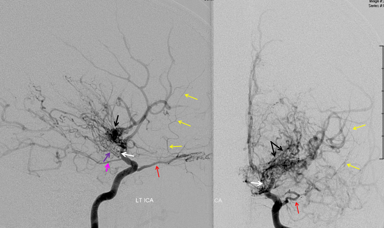 Dorsal Ophthalmic Artery