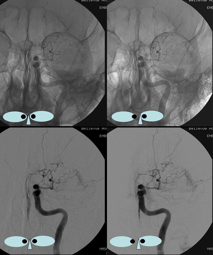 https://neuroangio.org/wp-content/uploads/Ophthalmic/Ophthalmic_intraorbital_branches_AP_stereo.png