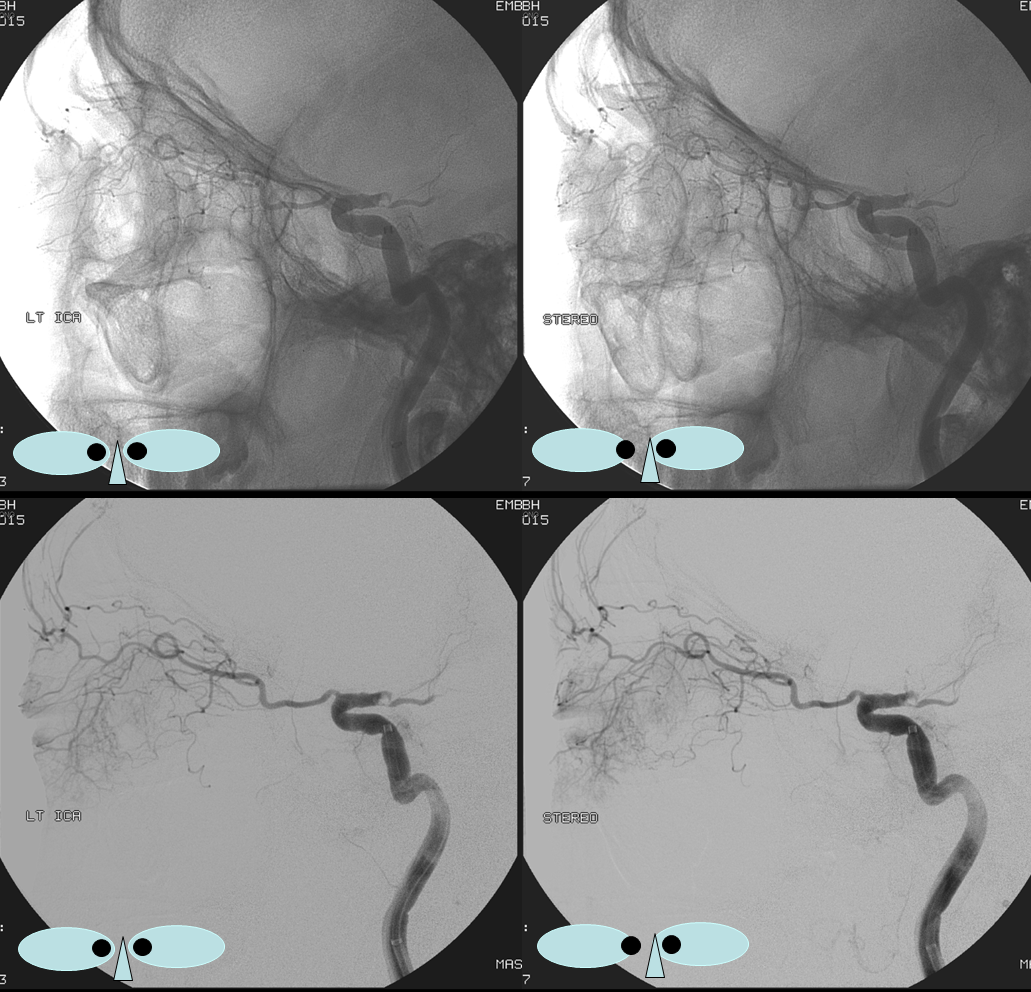 https://neuroangio.org/wp-content/uploads/Ophthalmic/Ophthalmic_intraorbital_branches_Lateral_stereo.png