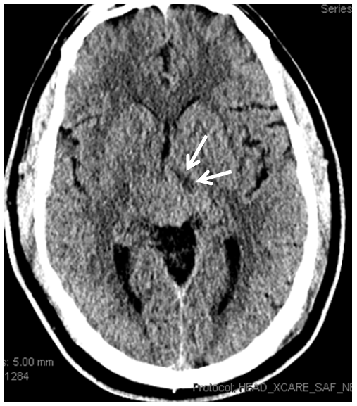 Posterior Cerebral Artery Collicular branch infarct