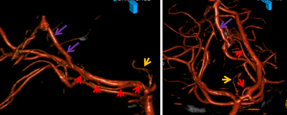 Posterior Cerebral Artery Collicular Branch