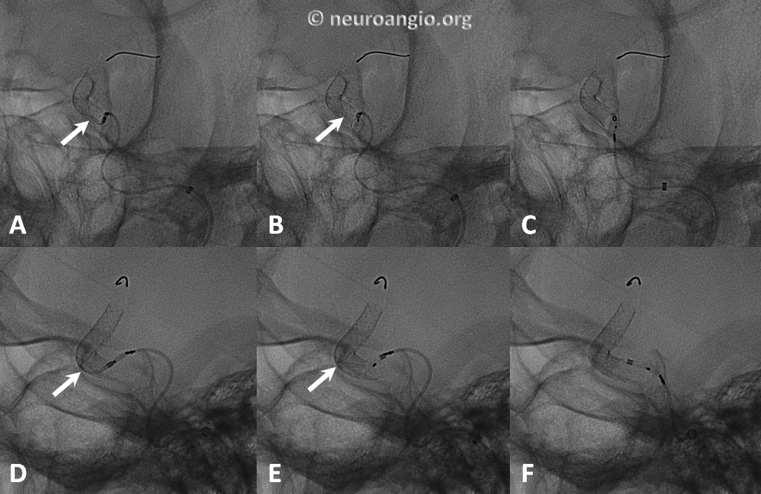 https://neuroangio.org/wp-content/uploads/PED/PED_Delivery_Torsion_Distal.png