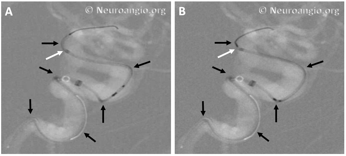 https://neuroangio.org/wp-content/uploads/PED/PED_Flex_Delivery_Resheathing_1.png