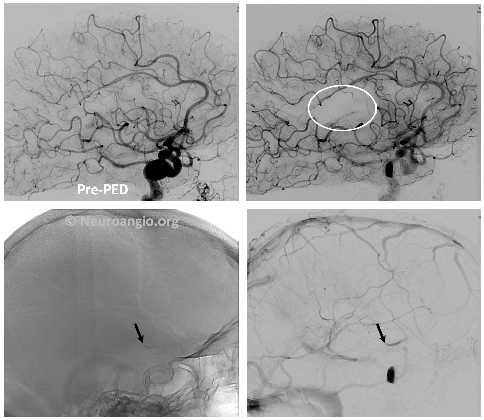 https://neuroangio.org/wp-content/uploads/PED/PED_Flex_Embolus_1.png