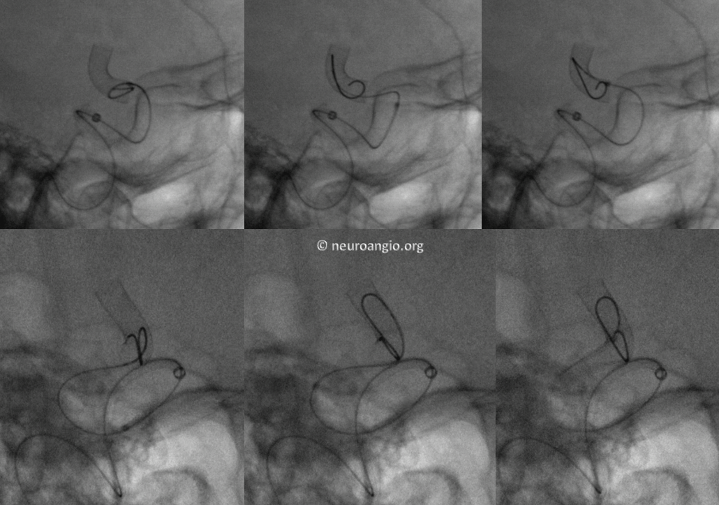 J-wire technique in vivo