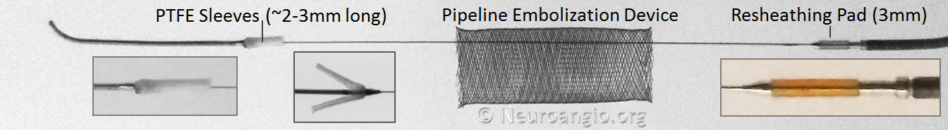 Pipeline Embolization Device and Flex Delivery System