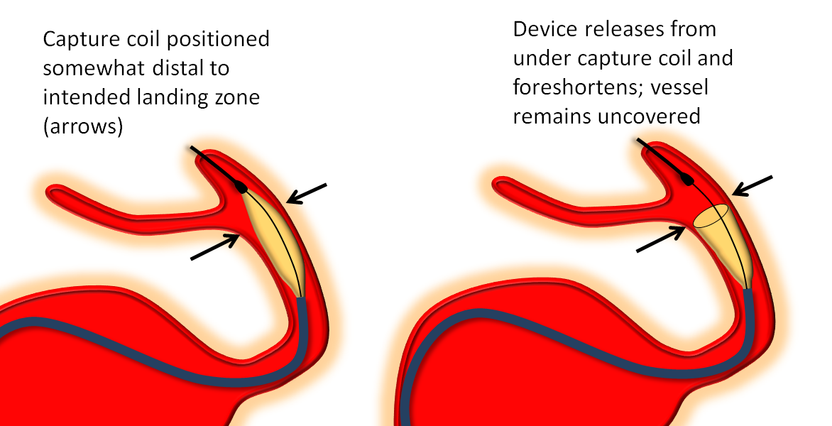 https://neuroangio.org/wp-content/uploads/PED/PED_foreshortening_schema.png