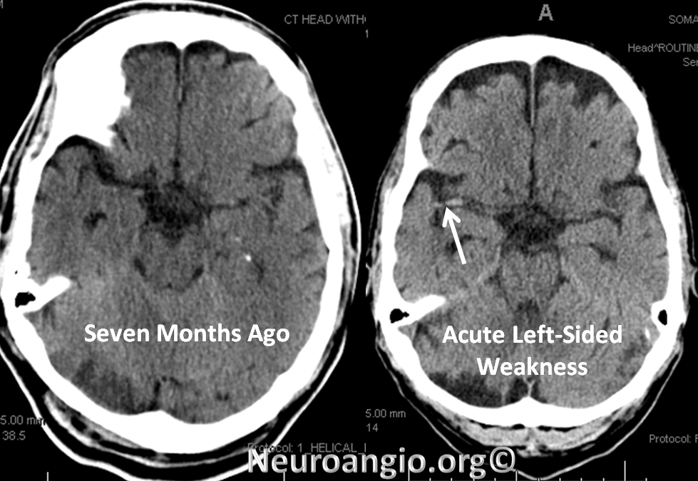 https://neuroangio.org/wp-content/uploads/Perfusion/Perfusion_22.png