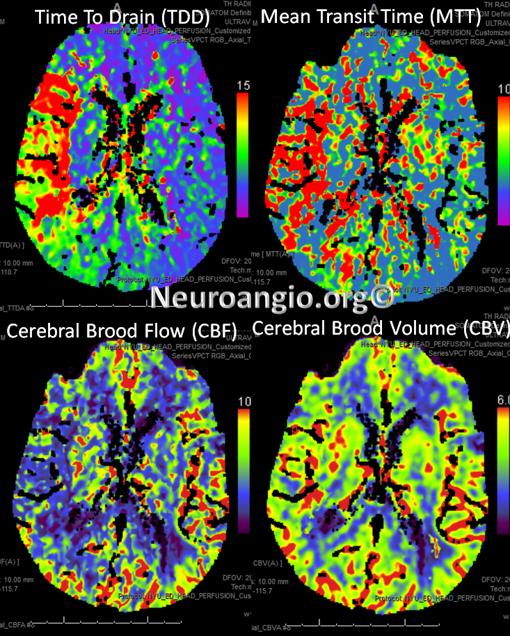 https://neuroangio.org/wp-content/uploads/Perfusion/Perfusion_25.png