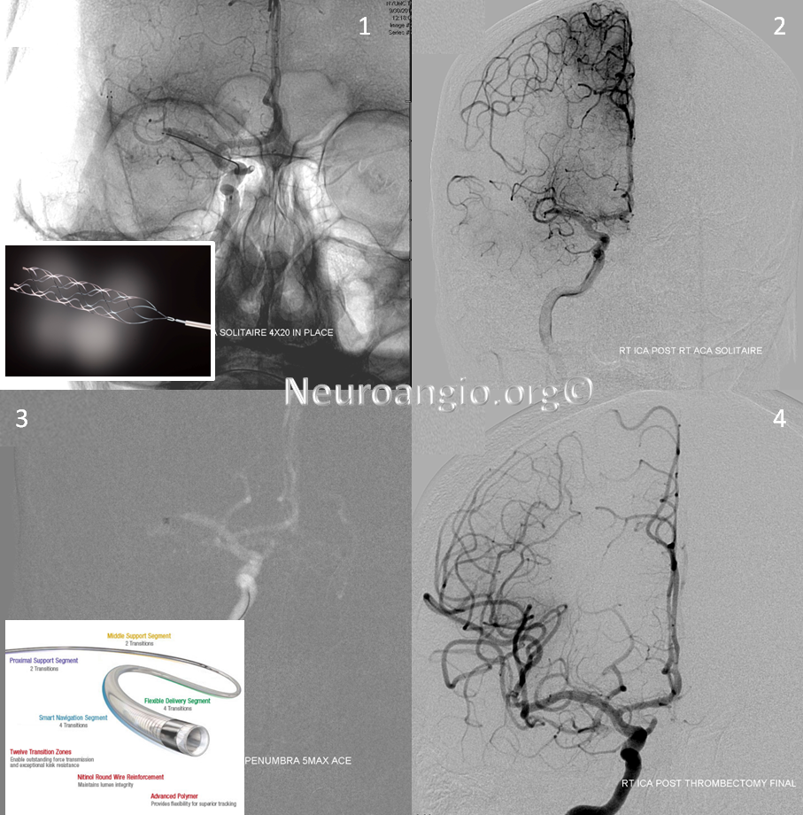 https://neuroangio.org/wp-content/uploads/Perfusion/Perfusion_26.png