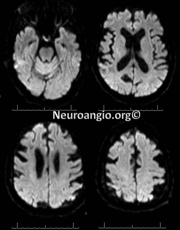 https://neuroangio.org/wp-content/uploads/Perfusion/Perfusion_27.png