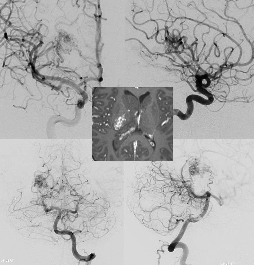 Posterior Choroidal Artery