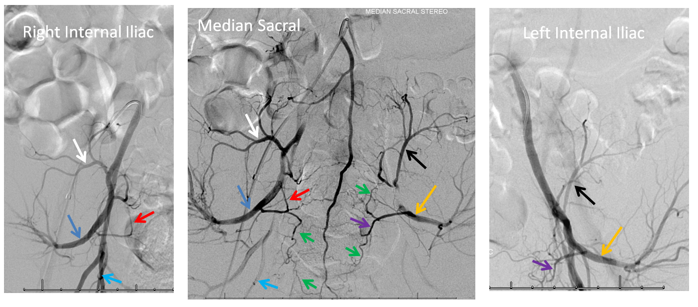 https://neuroangio.org/wp-content/uploads/Spinal/Spinal_Median_Sacral_Iliac_Anastomoses.png