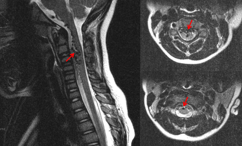 spinal vascular lesions classification table