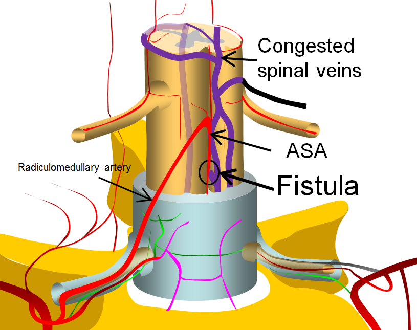 spinal intradural fistula