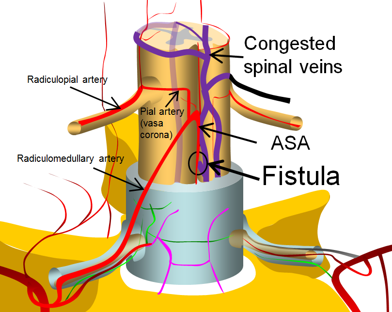 spinal intradural fistula