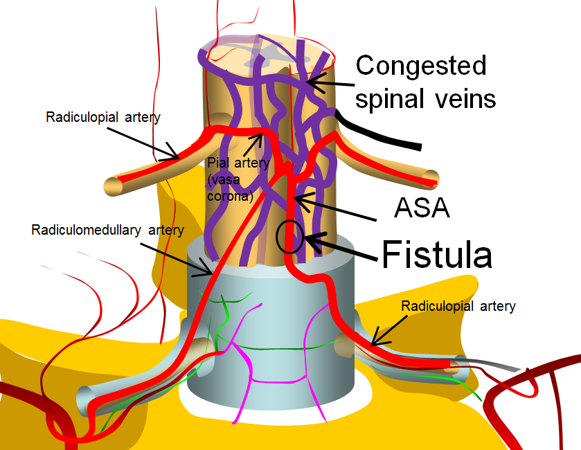spinal intradural fistula