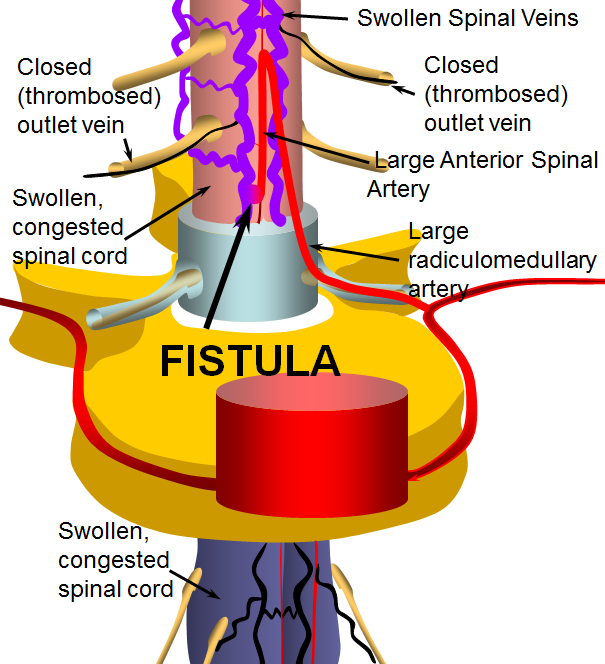 Spinal Intradural (Pial) Fistula | neuroangio.org