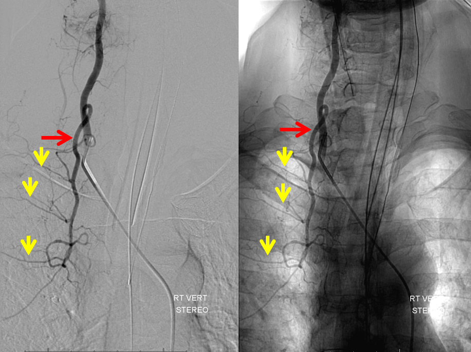 https://neuroangio.org/wp-content/uploads/Spinal/Spinal_supreme_intercostal_from_vert.png