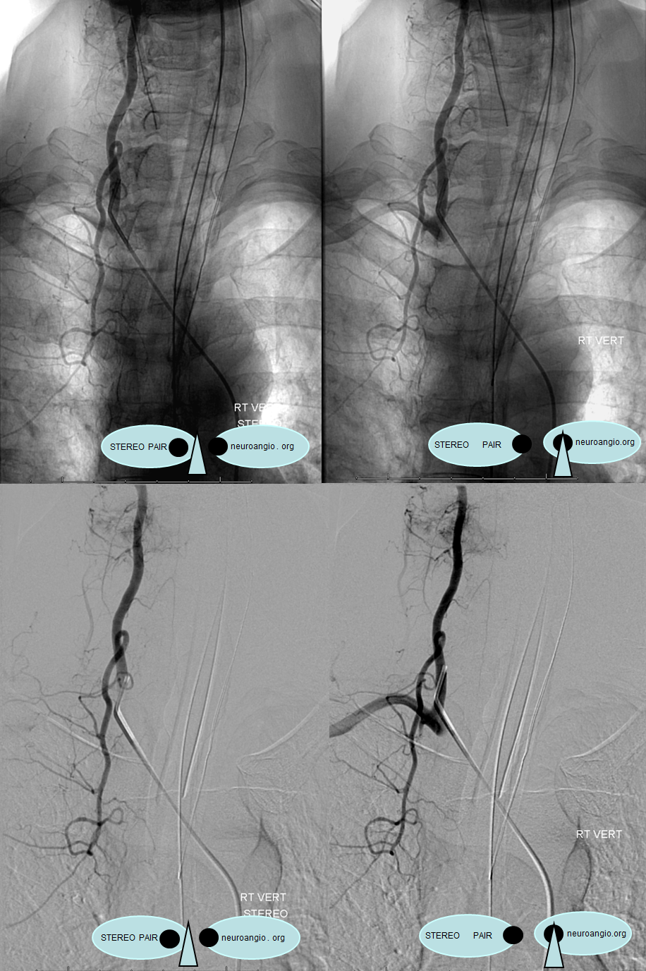 https://neuroangio.org/wp-content/uploads/Spinal/Spinal_supreme_intercostal_from_vert_stereo.png