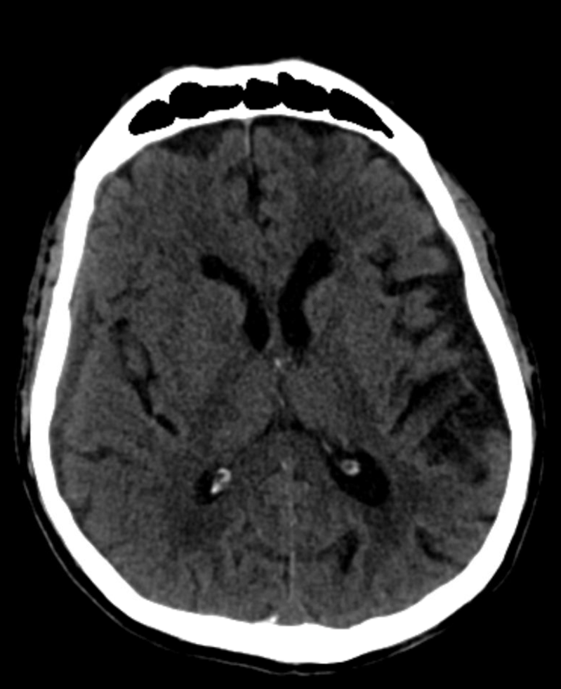 Subdural Hematoma Embolization | neuroangio.org