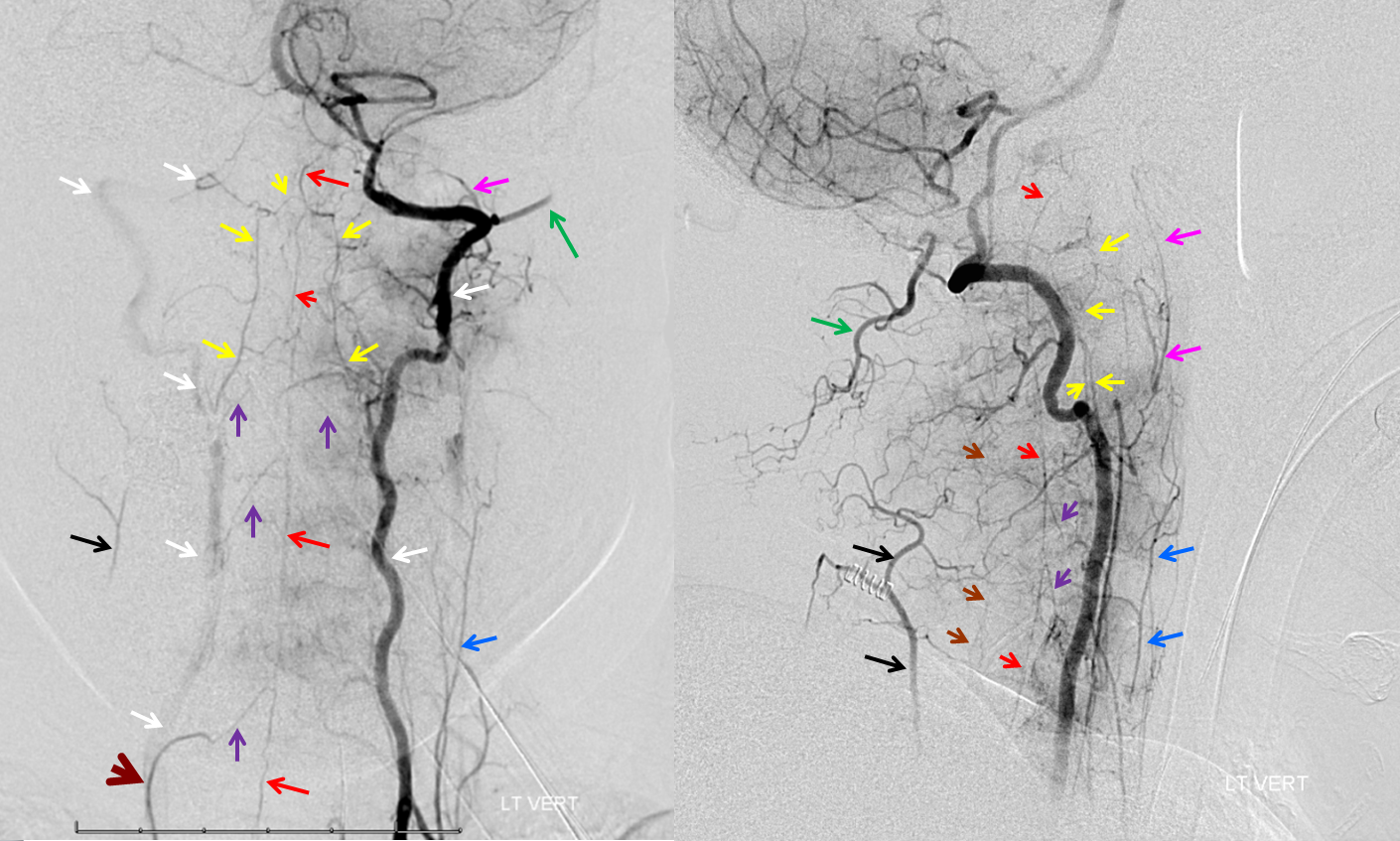 https://neuroangio.org/wp-content/uploads/VB/VA-ASA-entire-length-collaterals.png