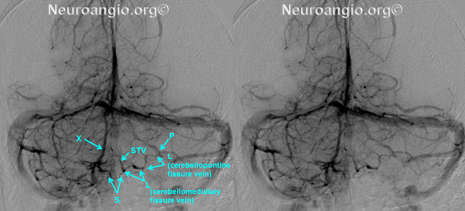 https://neuroangio.org/wp-content/uploads/Venous/Posterior_Fossa_Veins/V_lateral_recess_vein_tributaries.png