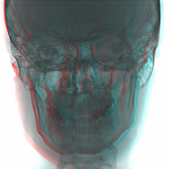 Skull anaglyph