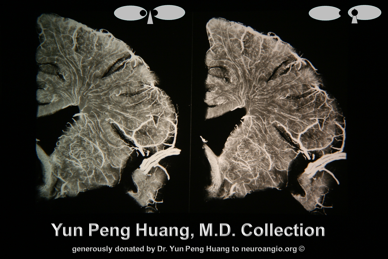 Yun Peng Huang stereo frontal veins